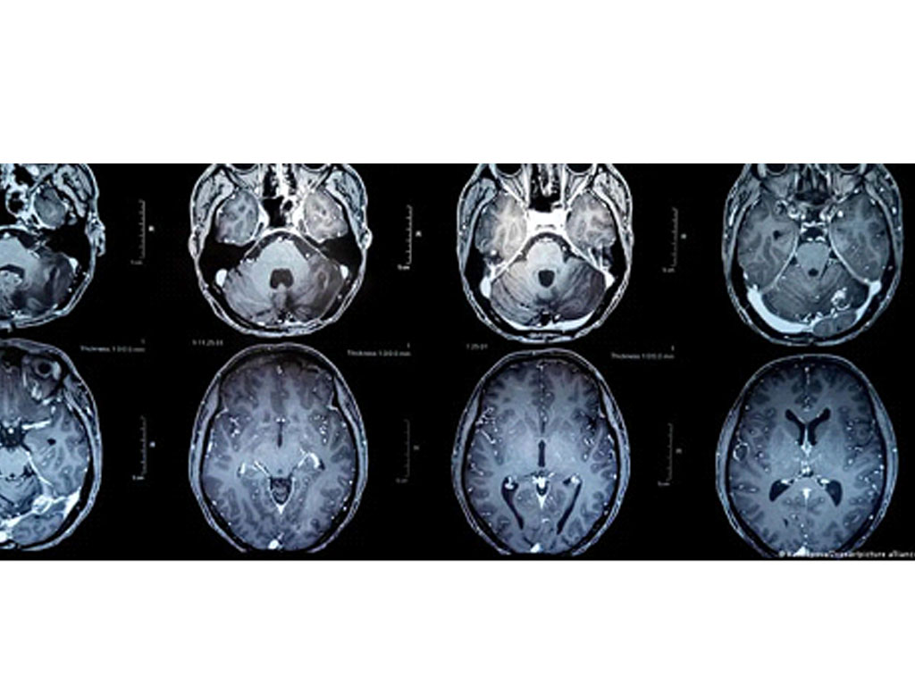 Vaksin Tumor Otak Tunjukkan Hasil yang Besar
